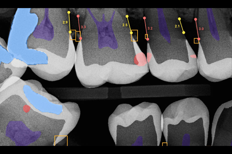 Laser Dentistry in Hoboken